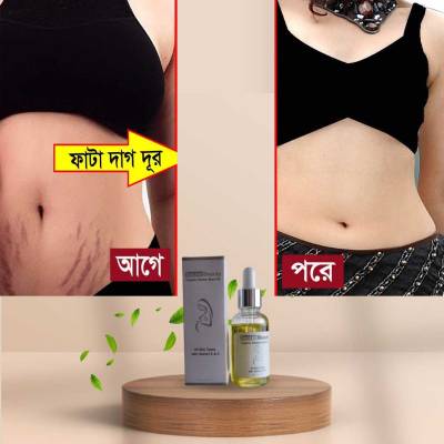 মাতৃত্বজনিত দাগ রিমুভ করার ওয়েল